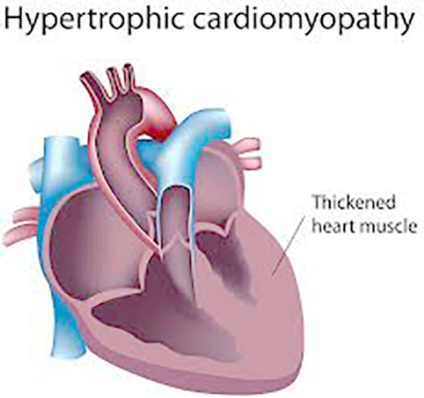 Bahrain News: Heart condition risk for children