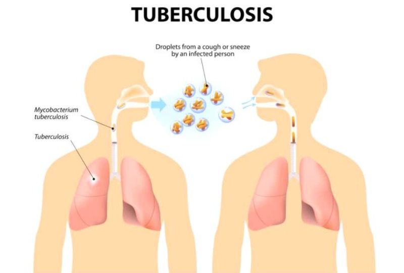 Health: Bahrain winning the battle against TB